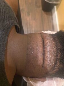 before treatment razor bumps and ingrown hairs on back of neck with inflammation and irritation