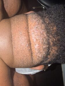 after 3 weeks treatment reduced razor bumps and ingrown hairs with smoother skin on neck”